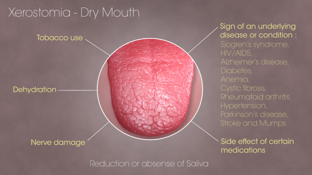 Dry mouth