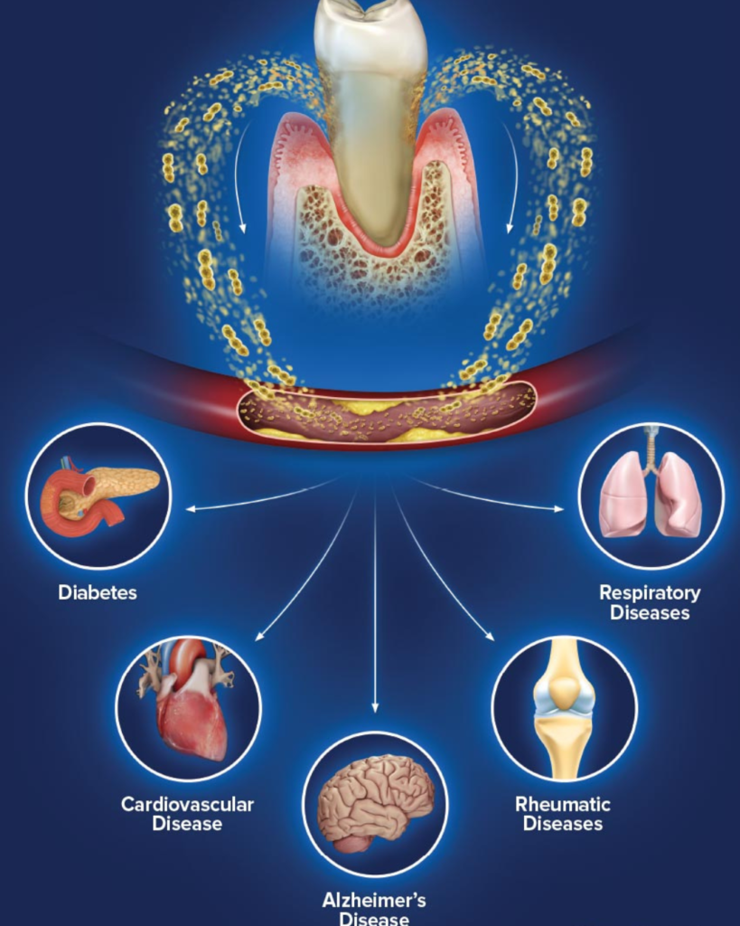 Gum disease