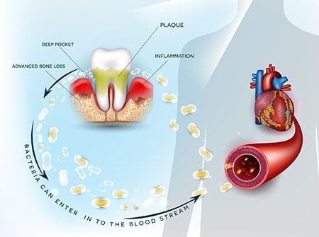 gum disease - Heart Disease