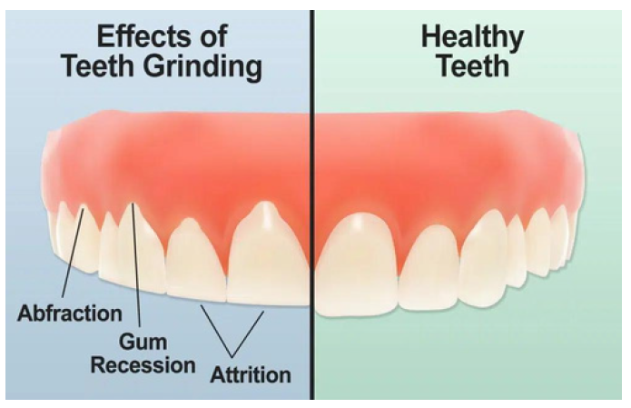 Teeth Grinding - Dental Pain