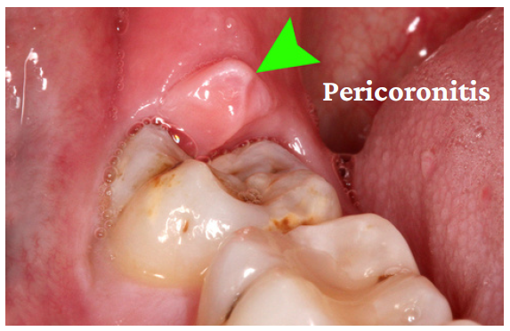 Pericoronitis - Dental Pain